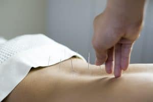 acupuncture treatment