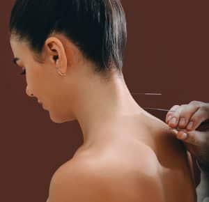 acupuncture treatments