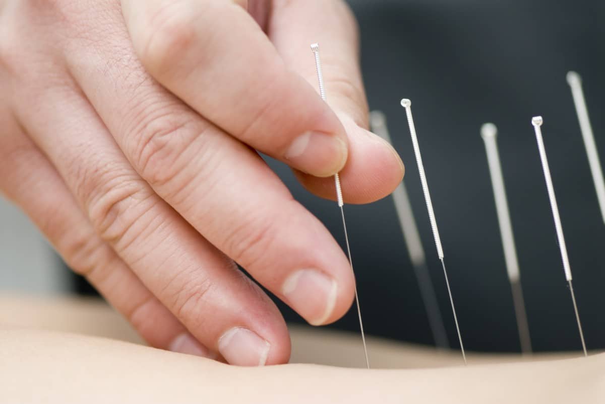 Acupuncture Practices