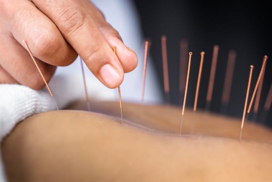 VA and acupuncture