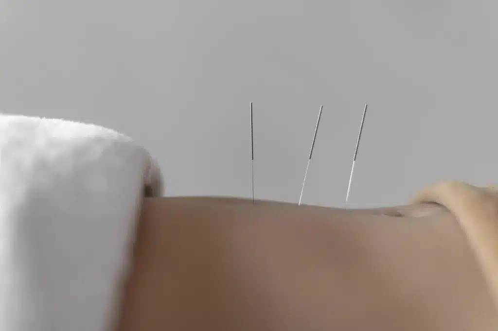 Acupuncture billing changes 2025