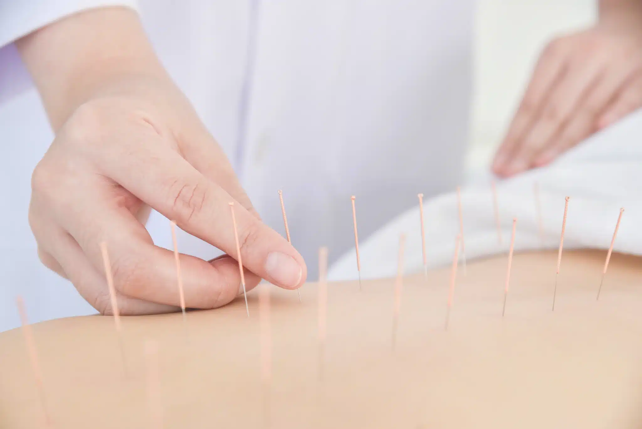 cpt code acupuncture