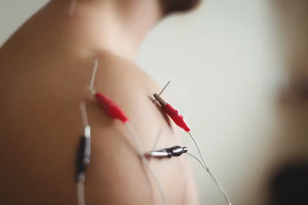 cpt code for acupuncture with electrical stimulation