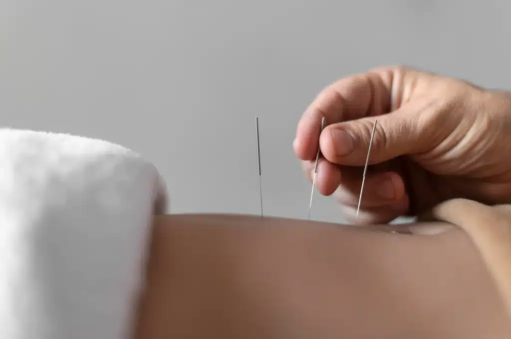 is acupuncture covered by medicaid