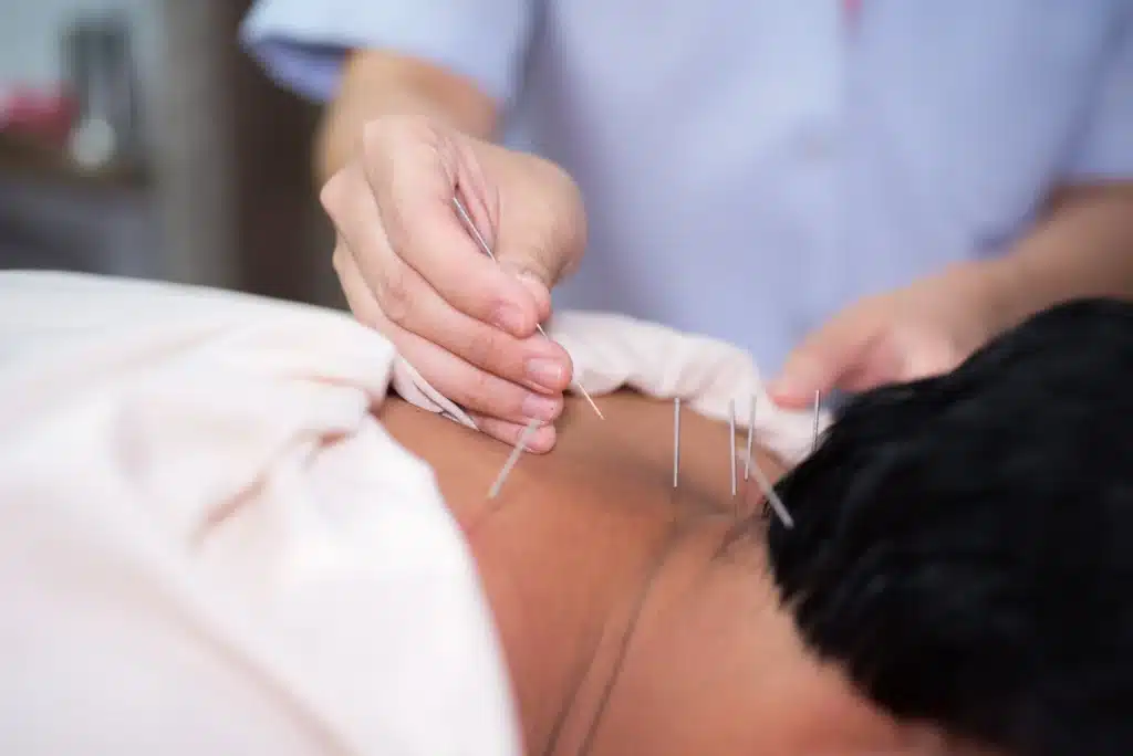 acupuncture cpt codes and modifiers