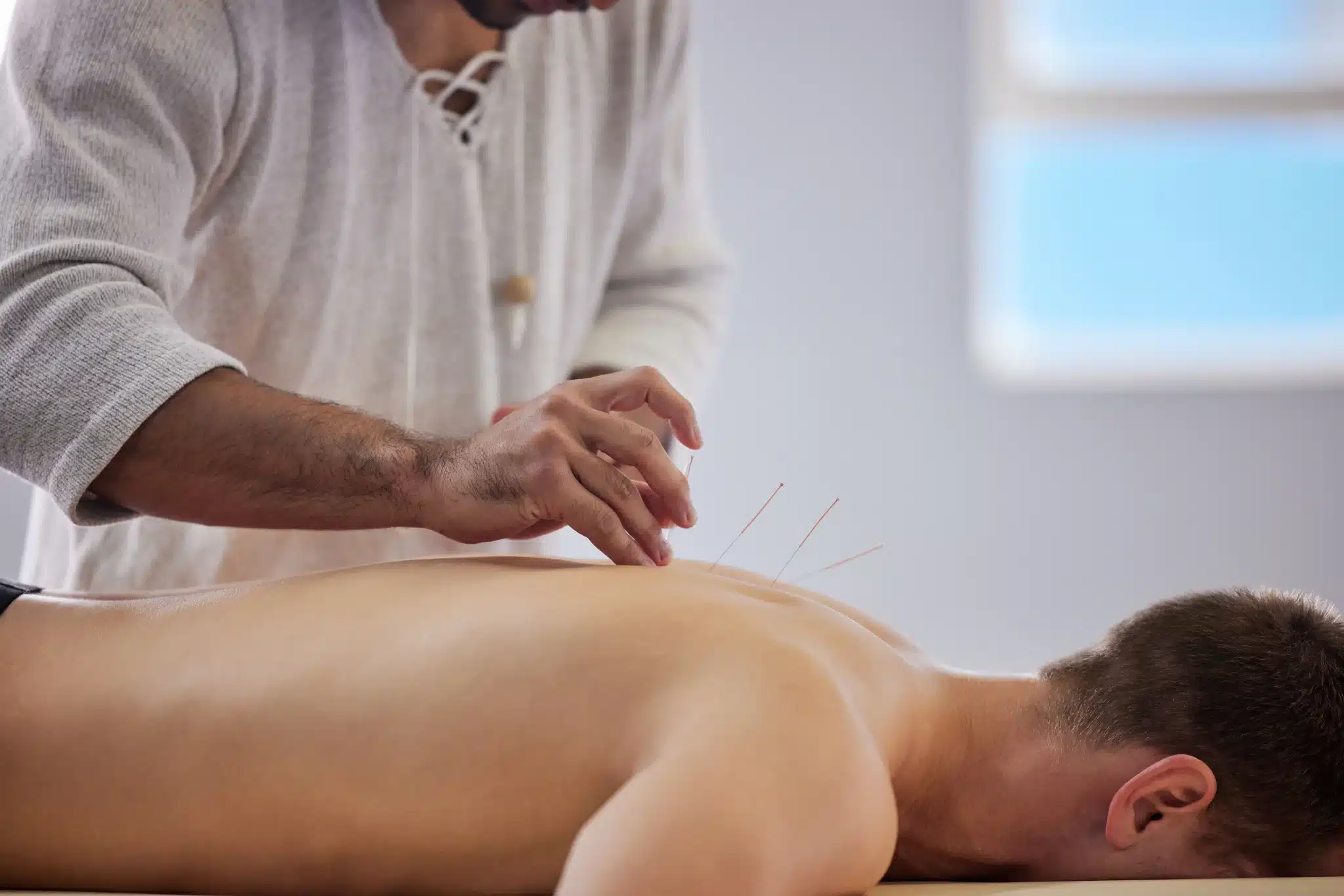 acupuncture procedure code