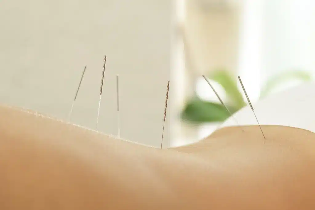 how to bill medicare for acupuncture