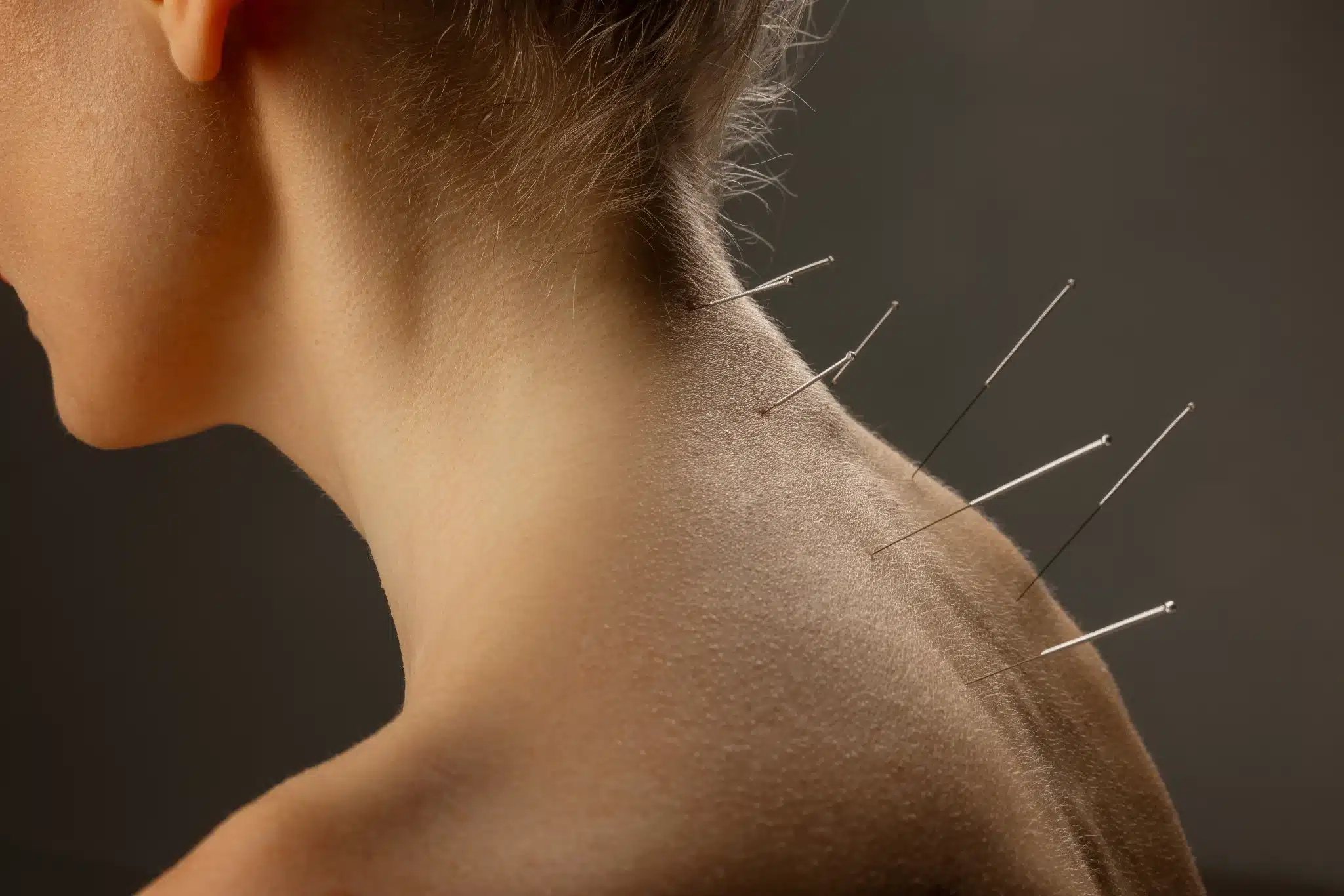 how to bill medicare for acupuncture